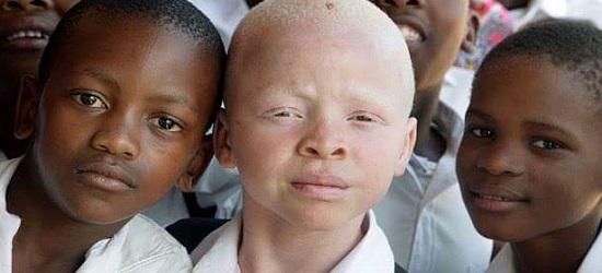 альбиносы как все