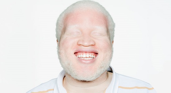 человек альбинос